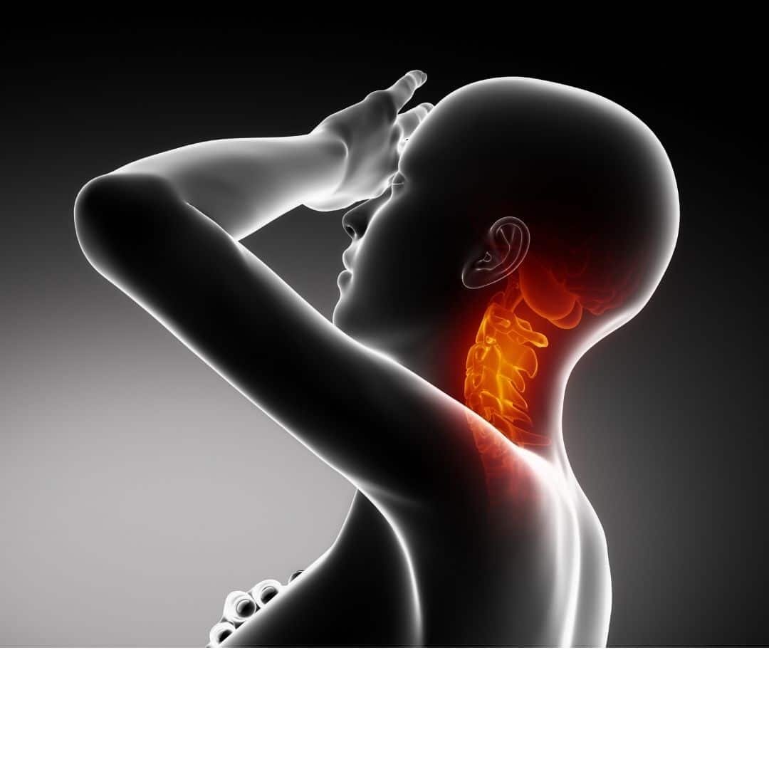 distonia cervical