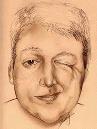 hemiespasmo facial