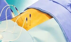 Radiofrequencia para dor cronica