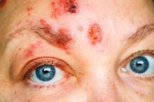 Neuro-Oncologia 19 neuralgia pos herpes zoster